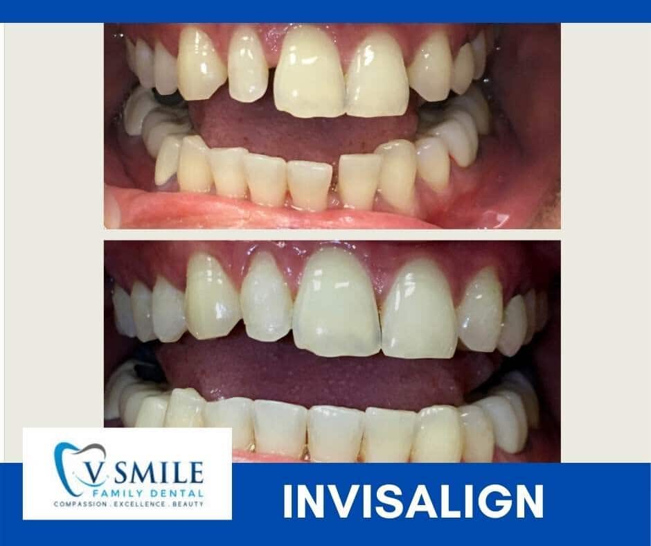 Smile makeover before and after