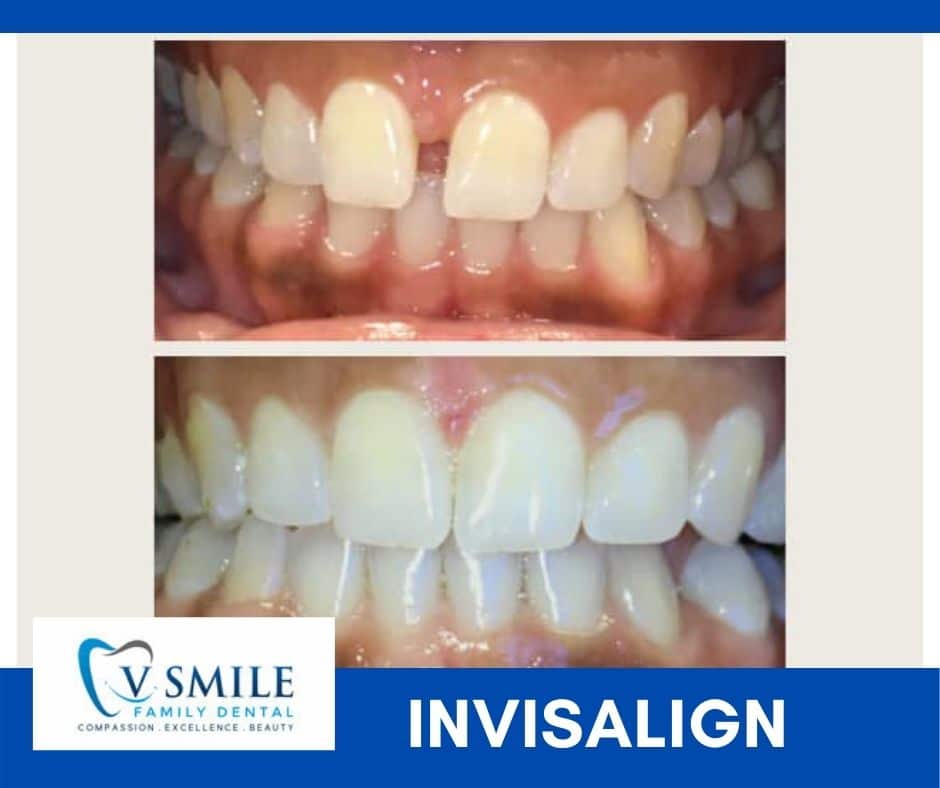 Before and after Invisalign treatment results