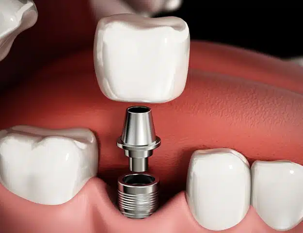 dental implants cost frisco tx