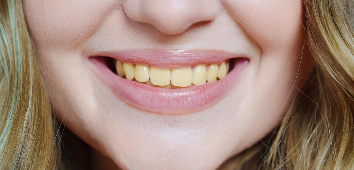 which vitamin deficiency causes yellow teeth