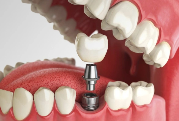 Oral Surgery In Panorama CA