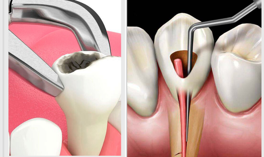 Root Canal Therapy and Tooth Extraction