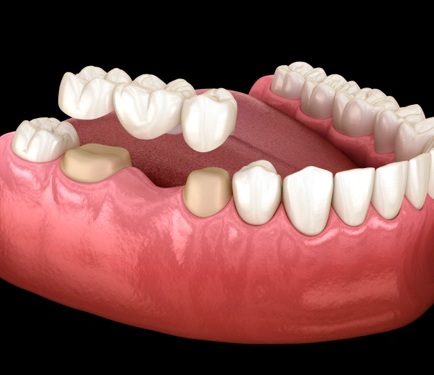 3D illustration of a dental bridge restoring missing teeth at The Dentist Place of Clearwater in Clearwater, FL