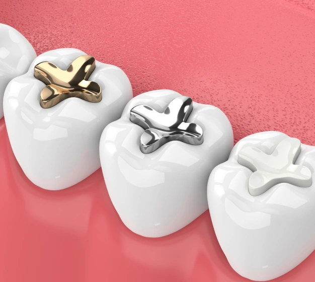 3D illustration of gold, silver, and tooth-colored dental fillings on molars at The Dentist Place of Clearwater in Clearwater, FL
