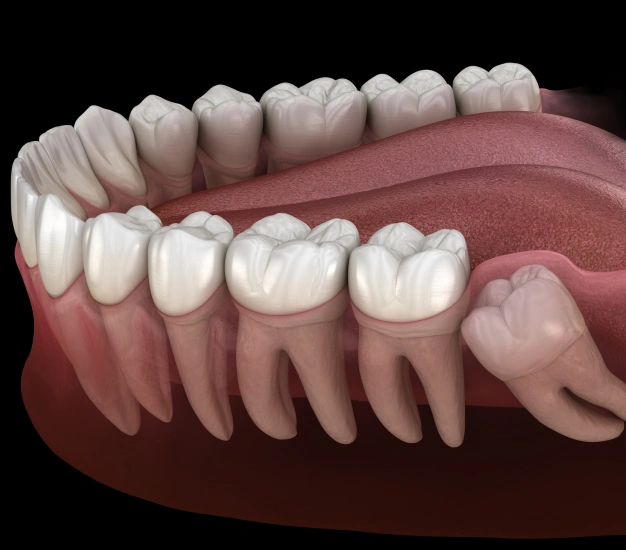 3D illustration of an impacted wisdom tooth growing at an angle beneath the gums at The Dentist Place of Clearwater in Clearwater, FL