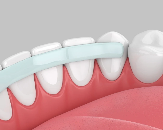 3D illustration of dental bonding resin being applied to teeth at The Dentist Place of Clearwater in Clearwater, FL