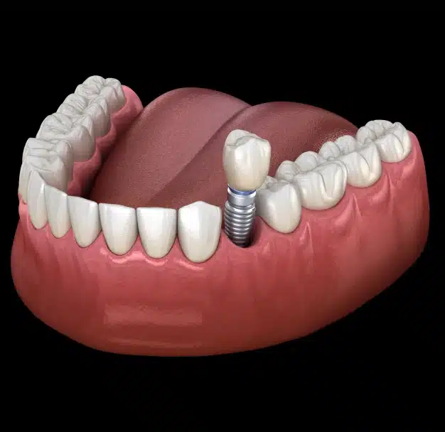3D illustration of a dental implant post placed in the lower jaw at The Dentist Place of Clearwater in Clearwater, FL