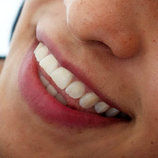 Close-up of person's smile showing bright, white teeth and healthy gums in dental practice setting.
