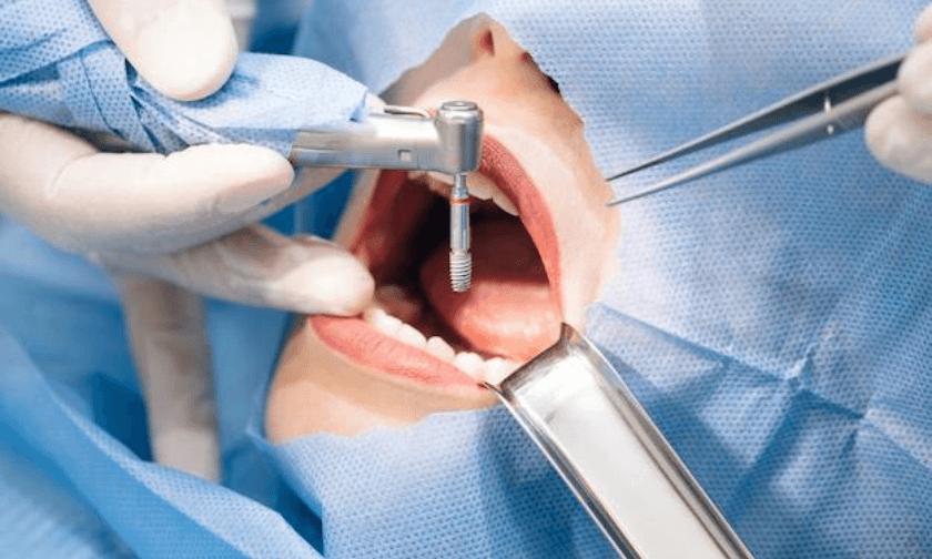 Dental Implants Scottsdale Dental Implants Scottsdale