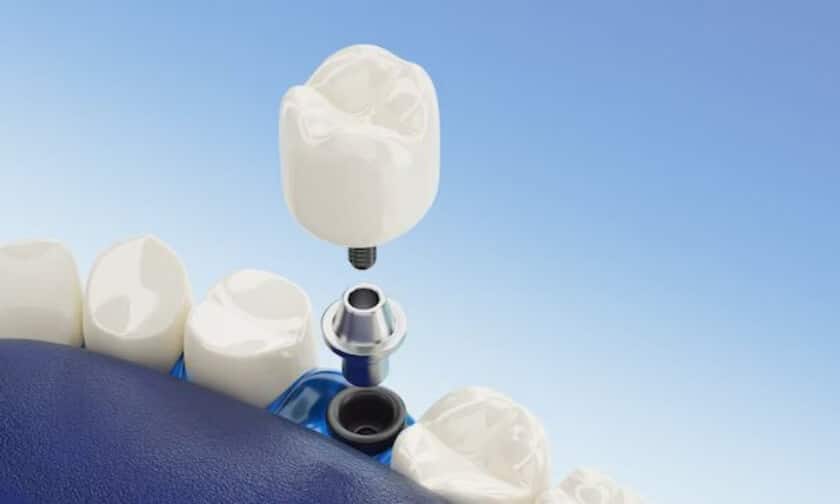 Dental Implants Scottsdale Dental Implants Scottsdale