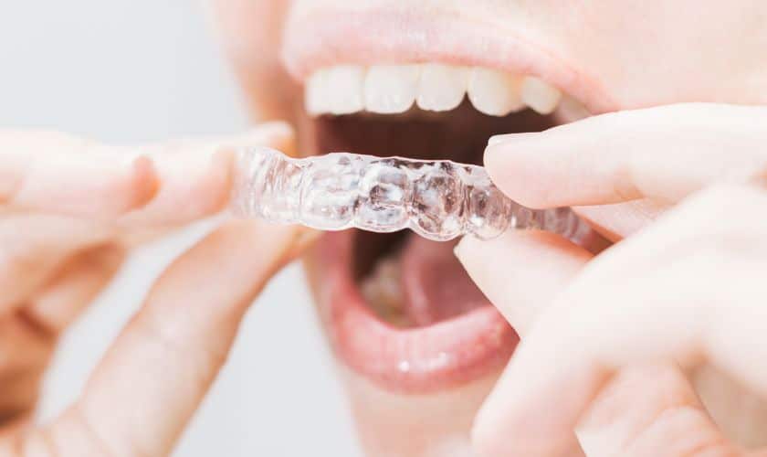 Invisalign Aligners Person inserting clear dental aligner into mouth for orthodontic treatment.