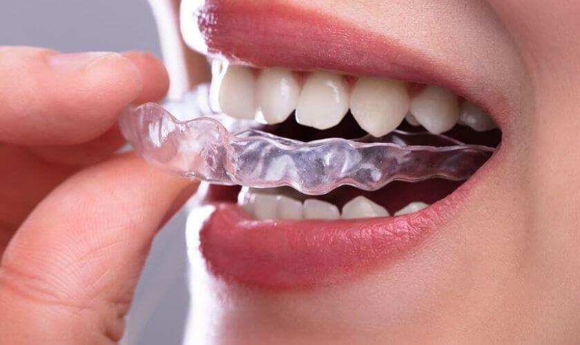 Invisalign in Scottsdale Invisalign in Scottsdale