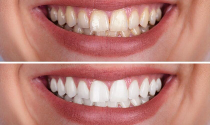 Common Teeth Stains & Whitening Solutions in Scottsdale Common Teeth Stains & Whitening Solutions in Scottsdale