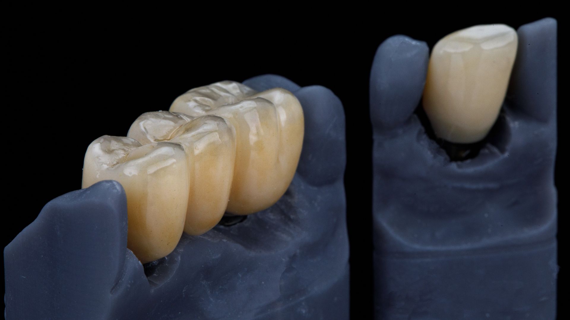 Dental Crowns Scottsdale Dental Crowns Scottsdale