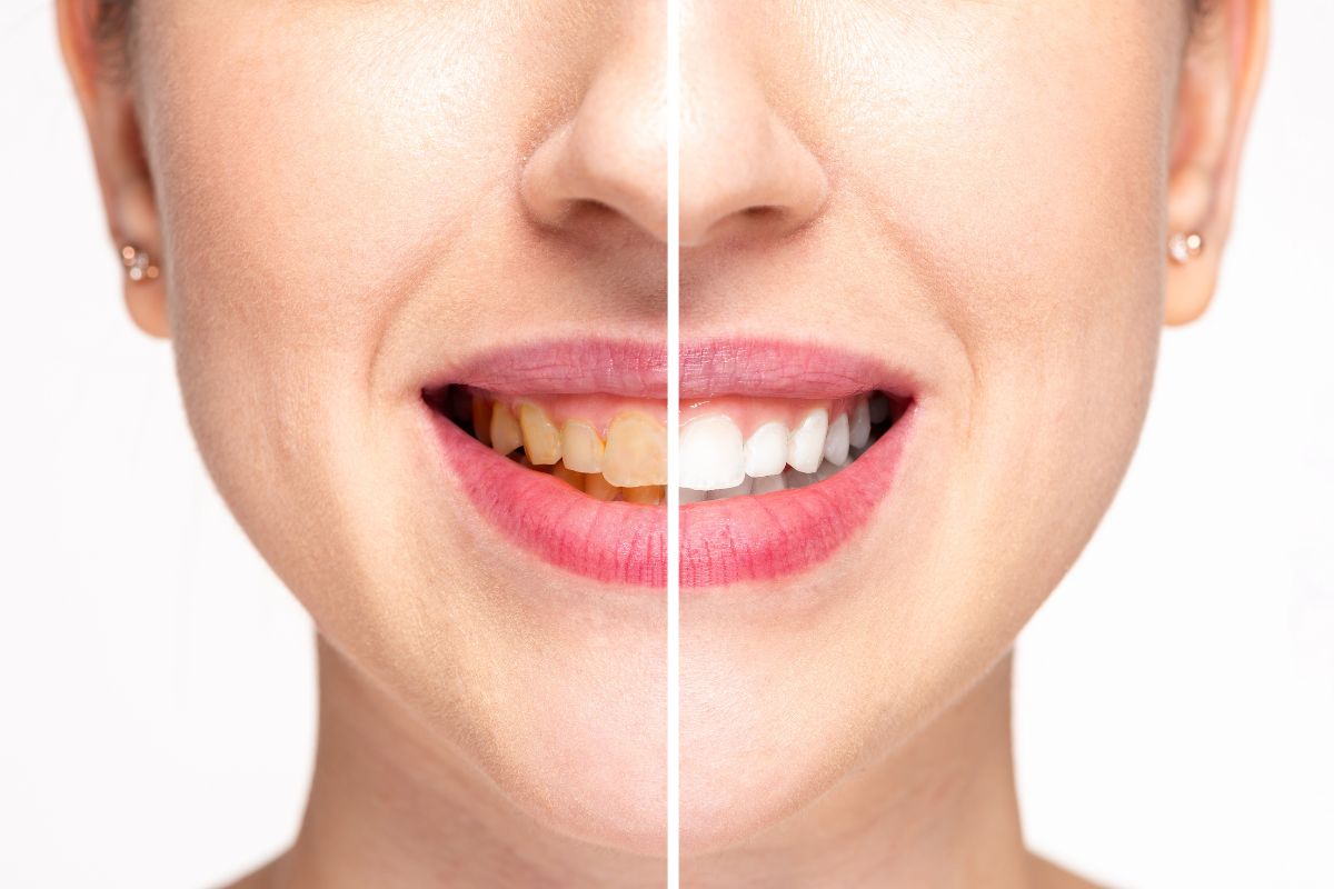 how to get rid of yellow stains on teeth