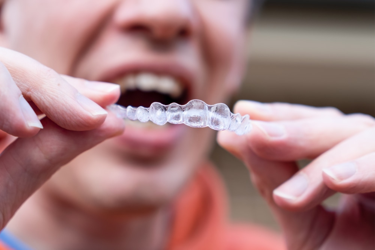 Gum Irritation from Invisalign? Causes & Relief Tips from Scottsdale Team Gum Irritation from Invisalign? Causes & Relief Tips from Scottsdale Team