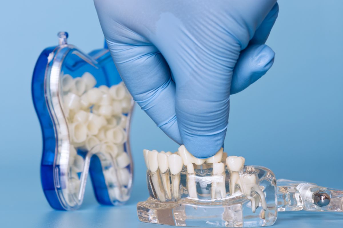Dental Crowns Scottsdale Dental Crowns Scottsdale