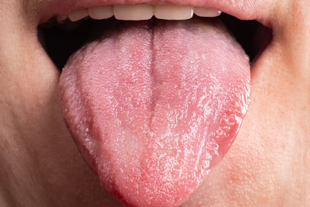 Bumps on Your Tongue Bumps on Your Tongue