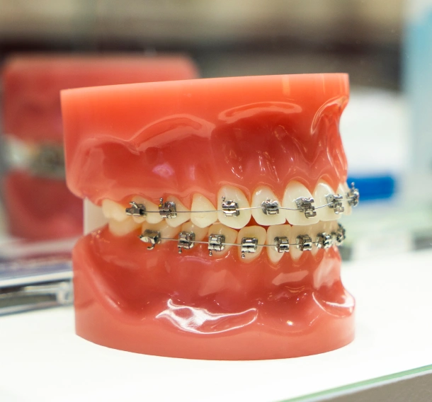 A dental model displaying orthodontic braces at Denver Orthodontics and Dental Lounge in Denver CO