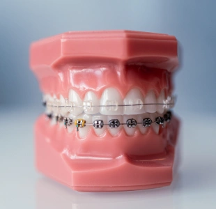 A dental model displaying metal braces on a pink background at Denver Orthodontics and Dental Lounge in Denver CO