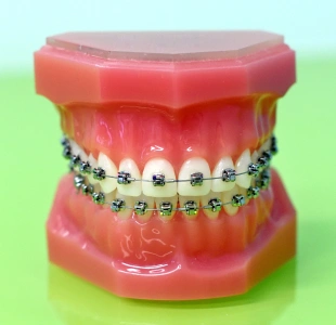 A dental model displaying orthodontic braces on a green background at Denver Orthodontics and Dental Lounge in Denver CO