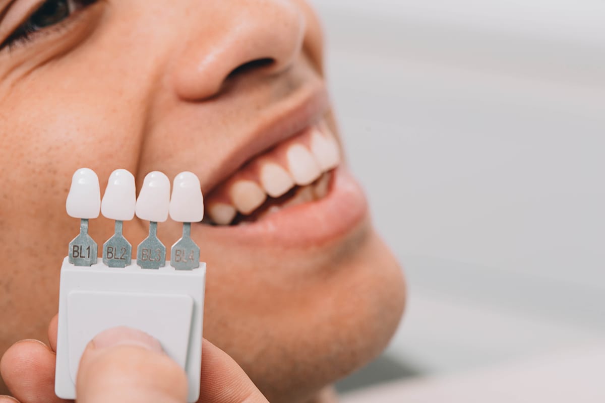Veneers in Sterling Heights