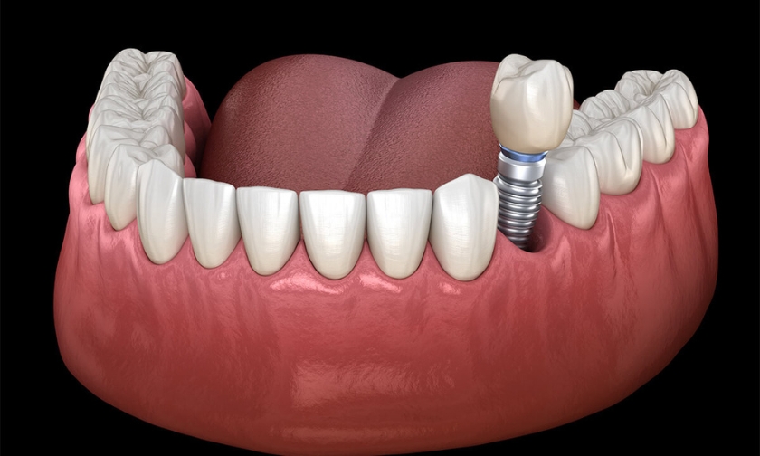 Dental Implants Help Preserve Oral Health