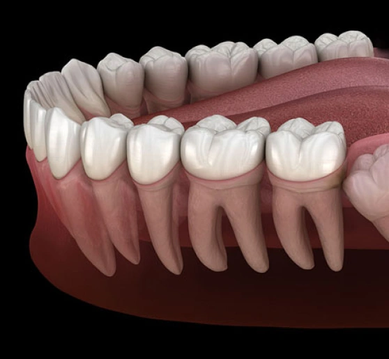 Wisdom teeth removal Holmdel, NJ