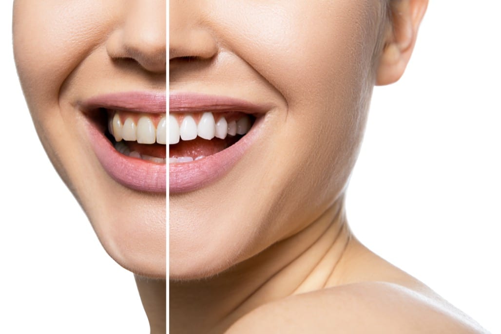 Teeth Whitening Treatment in Rocklin