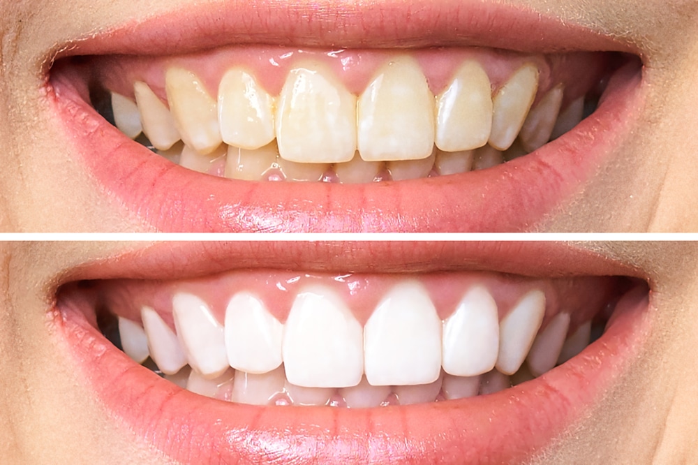 5 Questions to Consider Before Scheduling your Teeth Whitening Treatment | Rocklin CA
