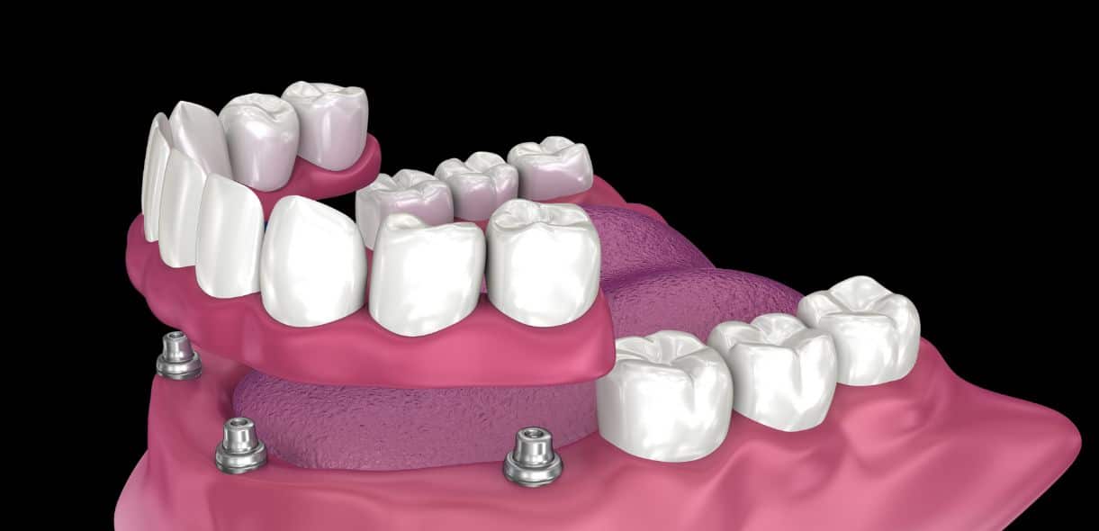 All You Need To Know About All In 4 And All In 6 Implants