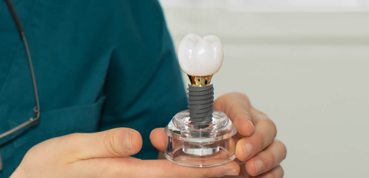7 Unknown Facts About Dental Implants
