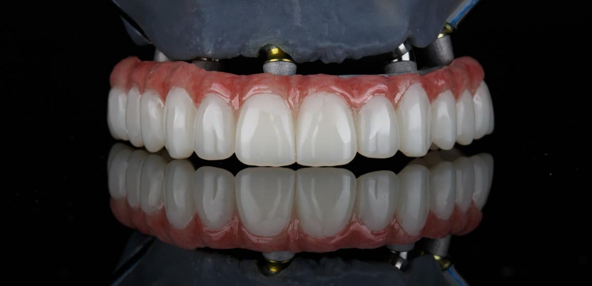All You Need to Know About All-on-X Dental Implants Procedure