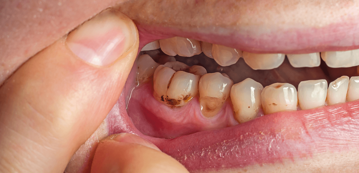How Do You Get Coffee Stains Off Your Teeth Fast?