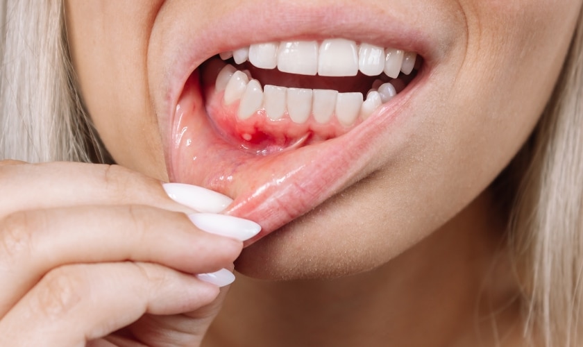 What is Gum Boil & How to Treat it