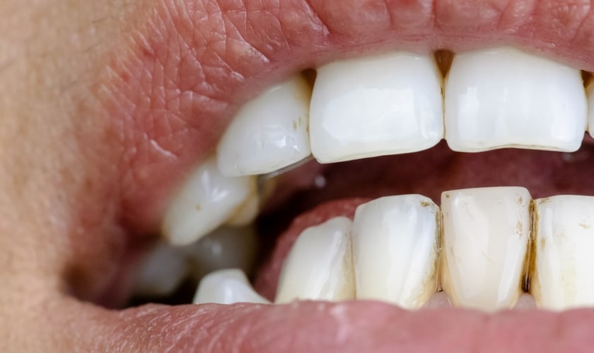 best ways to remove black stains from teeth