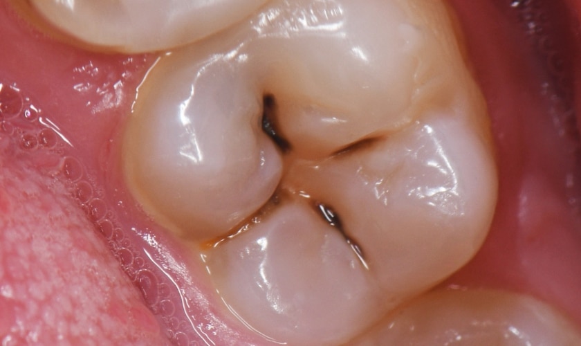 What Exactly Is a Cavity?