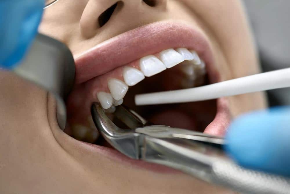 How to Take Care of Your Oral Hygiene After Tooth Extraction?