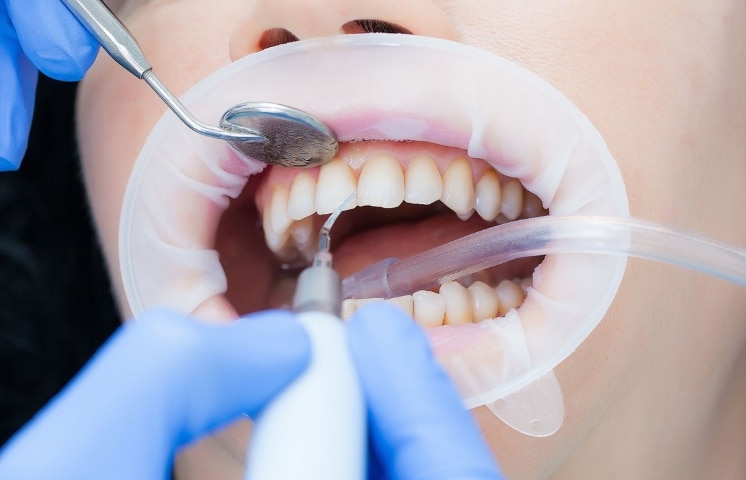 The Benefits of Professional Teeth Cleaning