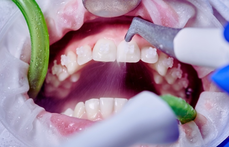 How Dental Cleanings Reduce the Risk of Tooth Decay in Hard-to-Reach Areas?