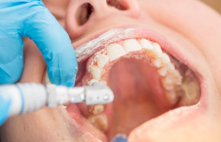 why some people need more frequent dental cleanings than others