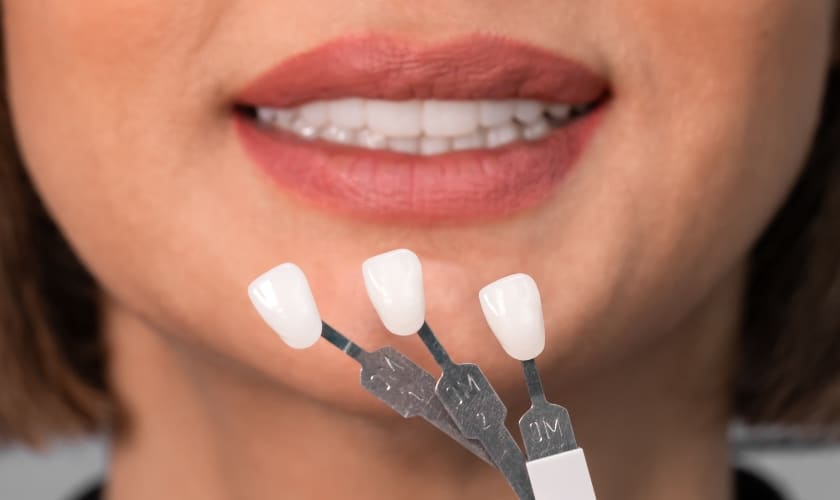 Are Veneers Permanent? Everything You Need to Know