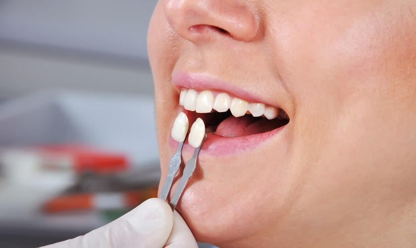 Can You Whiten Veneers? Here’s What You Need to Know