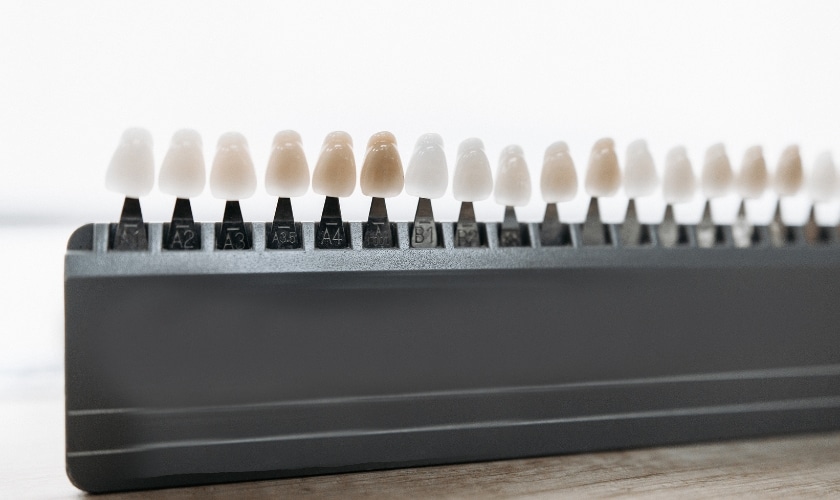 How Long Do Veneers Last? Lifespan and Replacement Guide