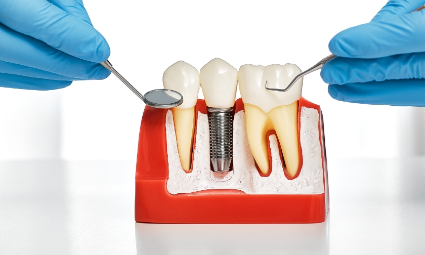 Dr. Jaclyn Pak’s Pre-Surgical Checklist for Optimal Dental Implant Success