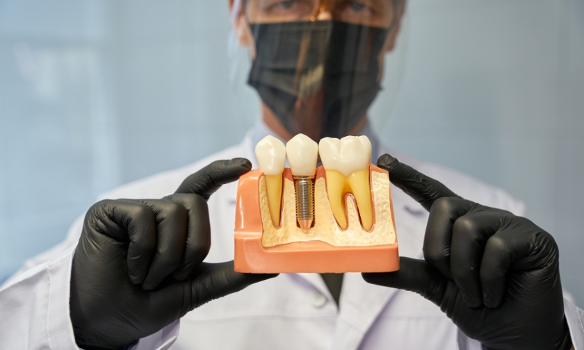 The Role of Hygiene: Best Practices for Cleaning and Protecting Your New Implants