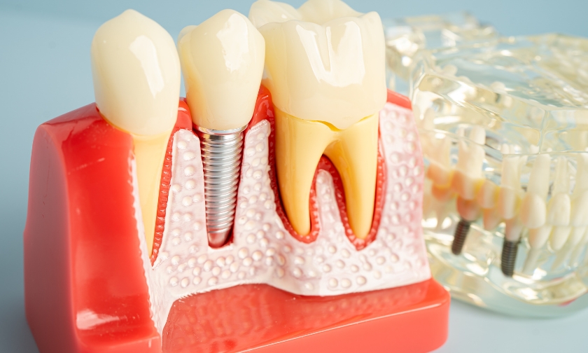 dental implants rocklin