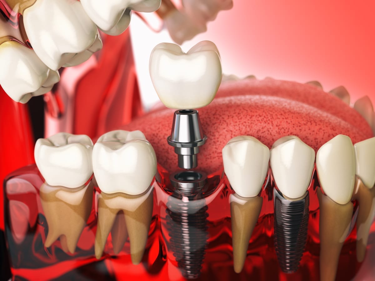 Dental Implants in Roseville