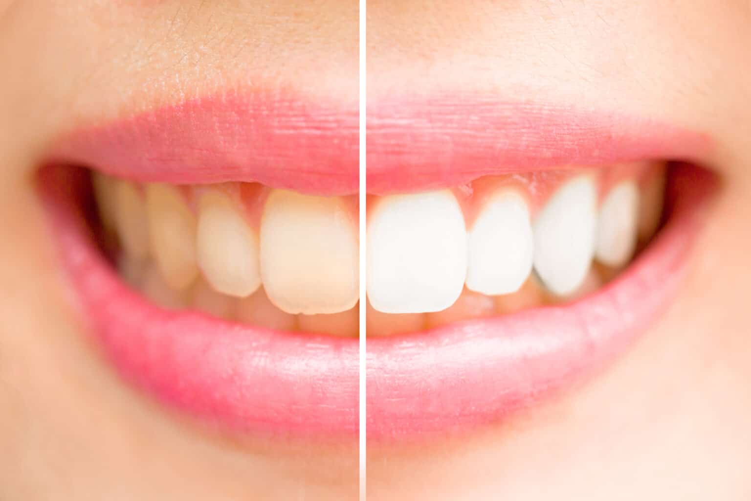 teeth whitening mountain home ar