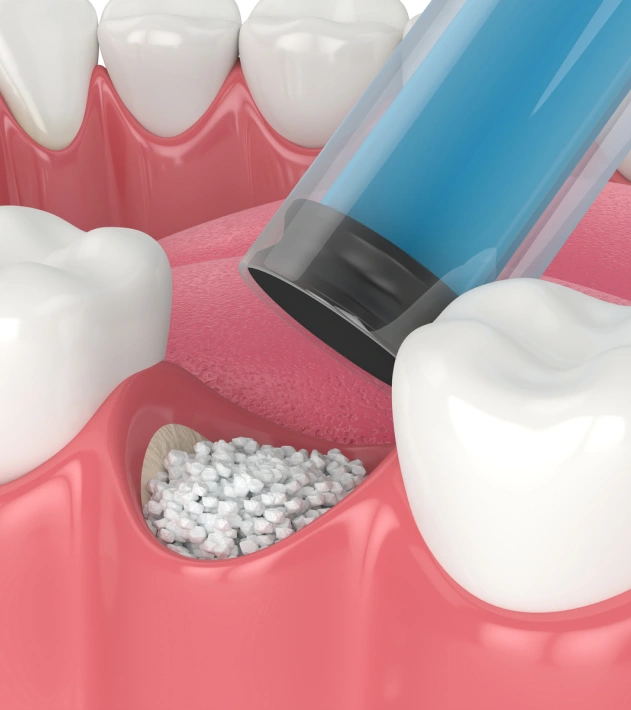 Bone Grafting For Dental Success